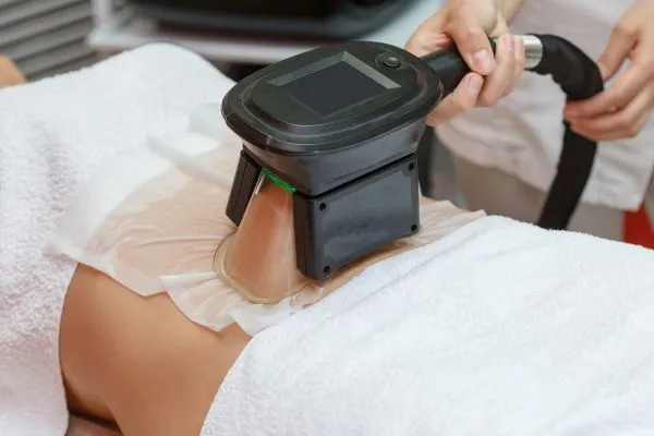 Image of person having fat freezing treatment to help weight gain Leatherhead