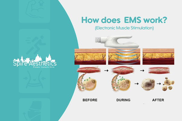 EMS treatment for post pregnancy weight loss treatment Leatherhead