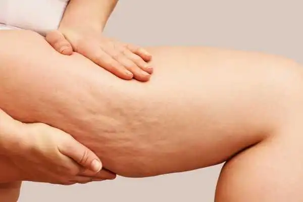 Image of woman showing leg with cellulite Leatherhead