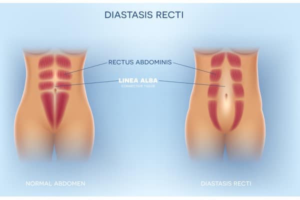 How Does Non-Surgical Treatment Help With Loose Skin, Weak Abdominal Muscles and Post-Pregnancy Changes Leatherhead?