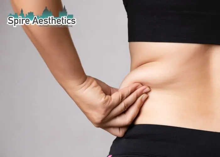 Image of woman pinching fat on their hips Leatherhead. Fat Freezing treatment