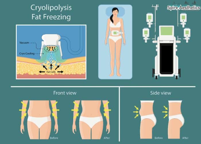 Image of diet and fat freezing combined for best results for Spire Aesthetics Leatherhead