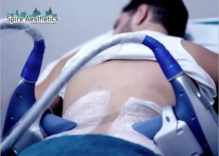 Man having fat freezing treatment done on love handles before a competitions Leatherhead to create a sculpted look.