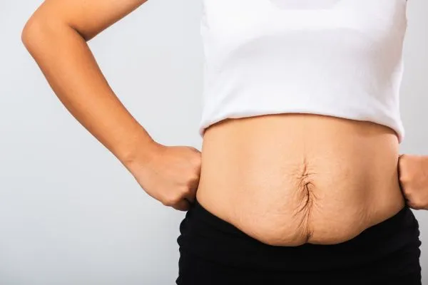 Image of a woman's stomach after weight loss with sagging skin following a gastric band Leatherhead