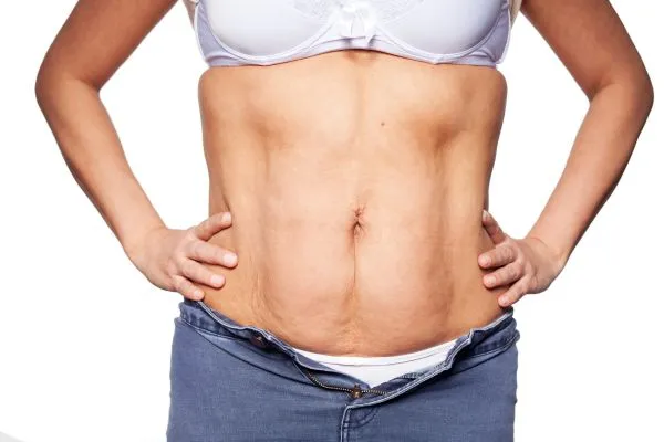 sagging skin on woman's stomach after weight loss injections Leatherhead