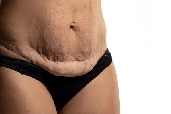Image of womans stomach after weight loss injections Leatherhead showing saggy skin