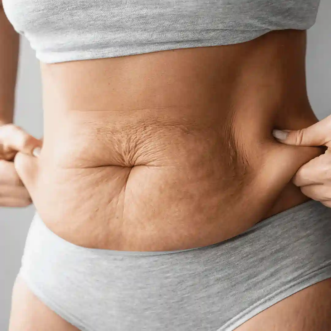 Is It Normal to Have Loose Skin After Pregnancy Leatherhead?