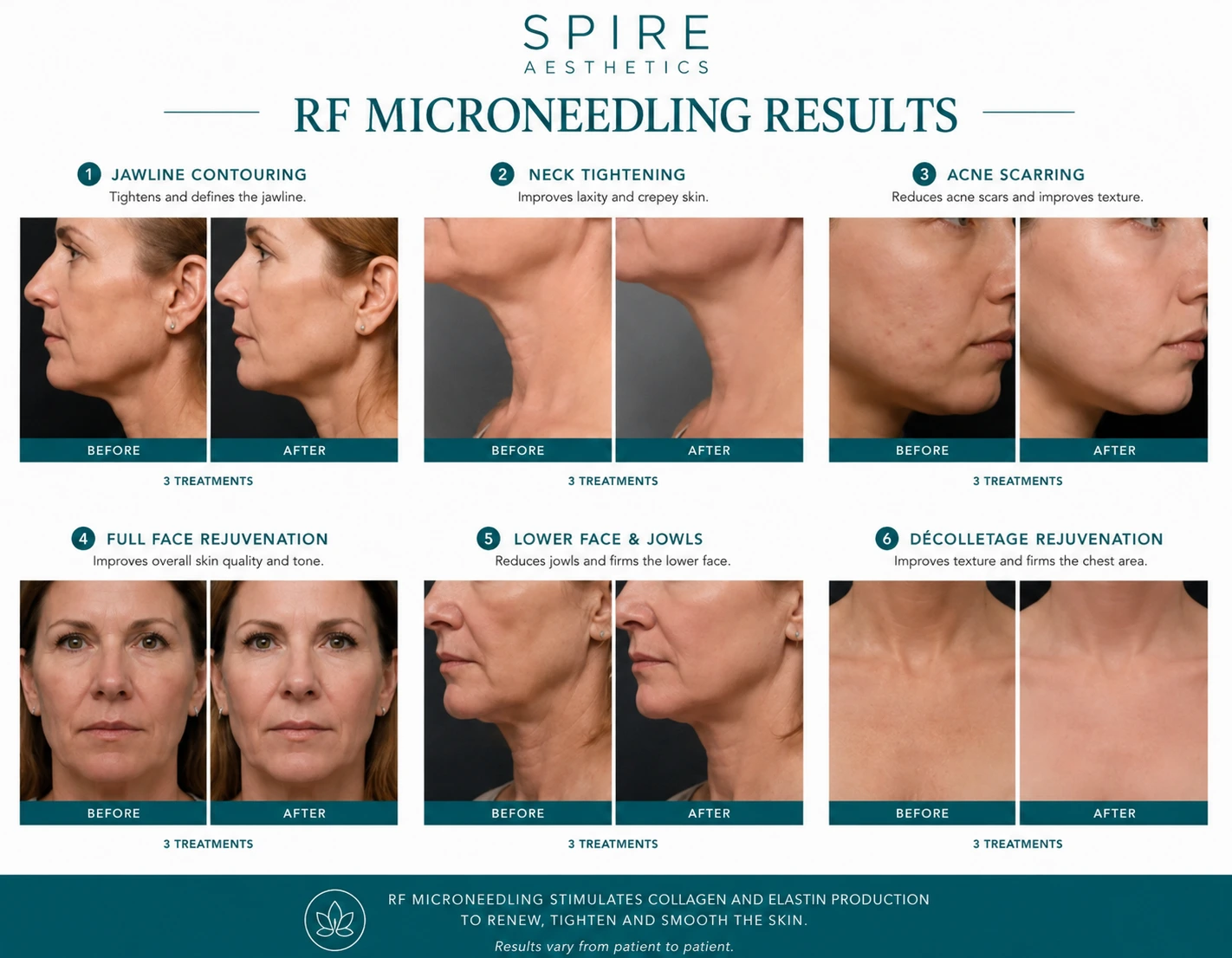 RF Microneedling Skin tightening Leatherhead results