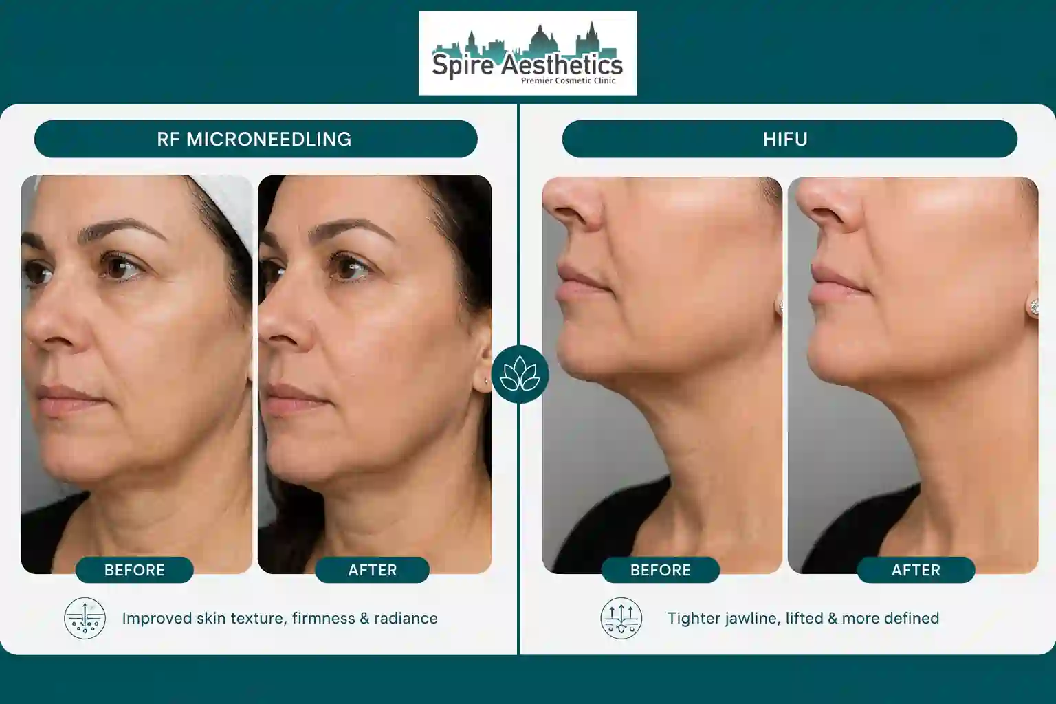 Can RF Microneedling and HIFU Be Combined Leatherhead?