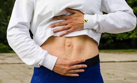 When Could Diastasis Recti Be the Missing Piece of the Puzzle Leatherhead?