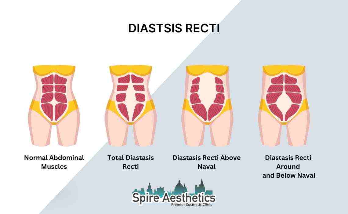 Is Non-Surgical Diastasis Recti Treatment Right for You? Common Concerns Answered Leatherhead